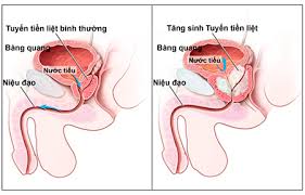 Thực phẩm phòng ngừa ung thư tuyến tiền liệt